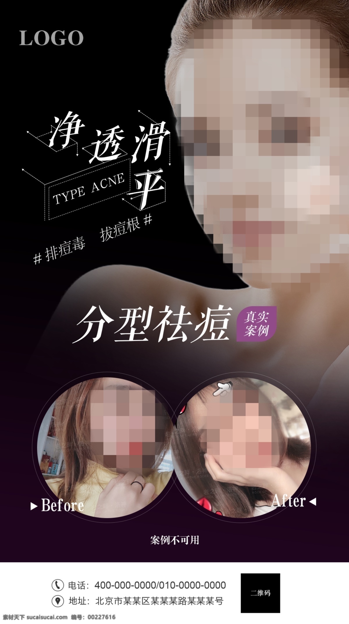祛痘 整形 醫(yī)美 醫(yī)學(xué)美容 整形海報 美容整形 整形美容 美女 醫(yī)美整形海報 微整形 微整形海報 玻尿酸 美容海報 面部整形 韓式整形 整形醫(yī)院 面部美學(xué) 面部微整形 面部微雕 抗衰 抗衰老 隆鼻 美鼻 面部線雕 線雕 祛斑 美白 瘦臉 面雕 美容 醫(yī)美整形 醫(yī) 美 移動 端 海報