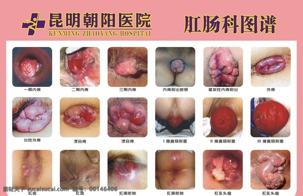 肛肠疾病图谱 肛肠图谱 肛肠疾病图 痔疮图谱 肛肠科 图谱 大全 肛门 肛门疾病 医院挂图 医院展板 视觉 展板 展板模板 矢量