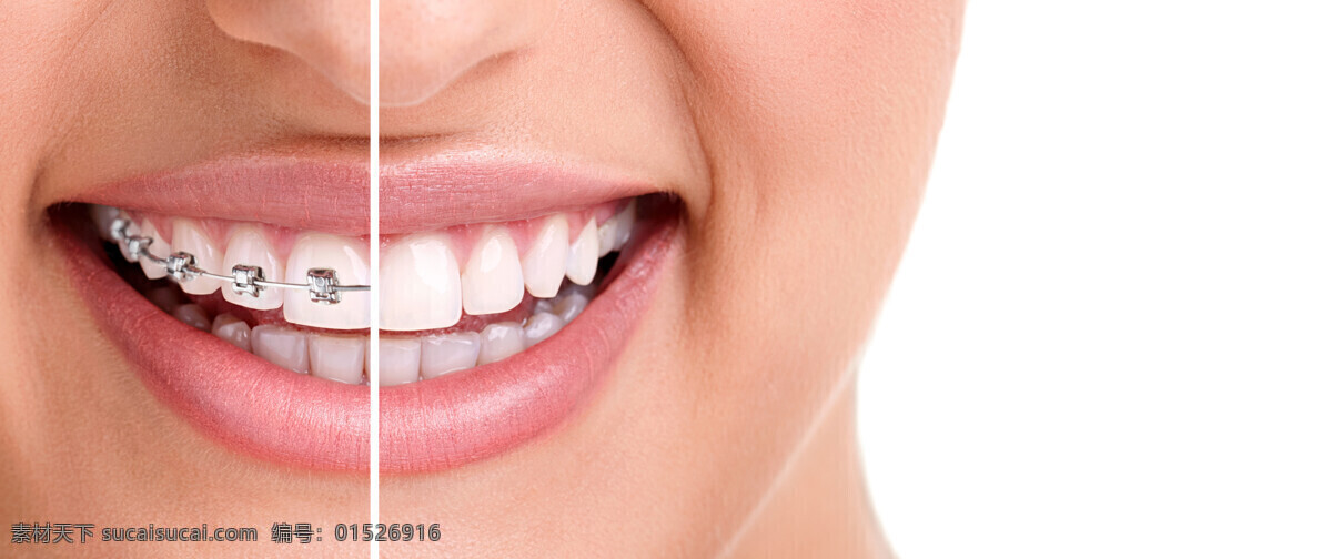 牙齿矫正 洁白牙齿 牙套 牙科 健康牙齿 牙齿美白 人体器官图 医疗护理 现代科技