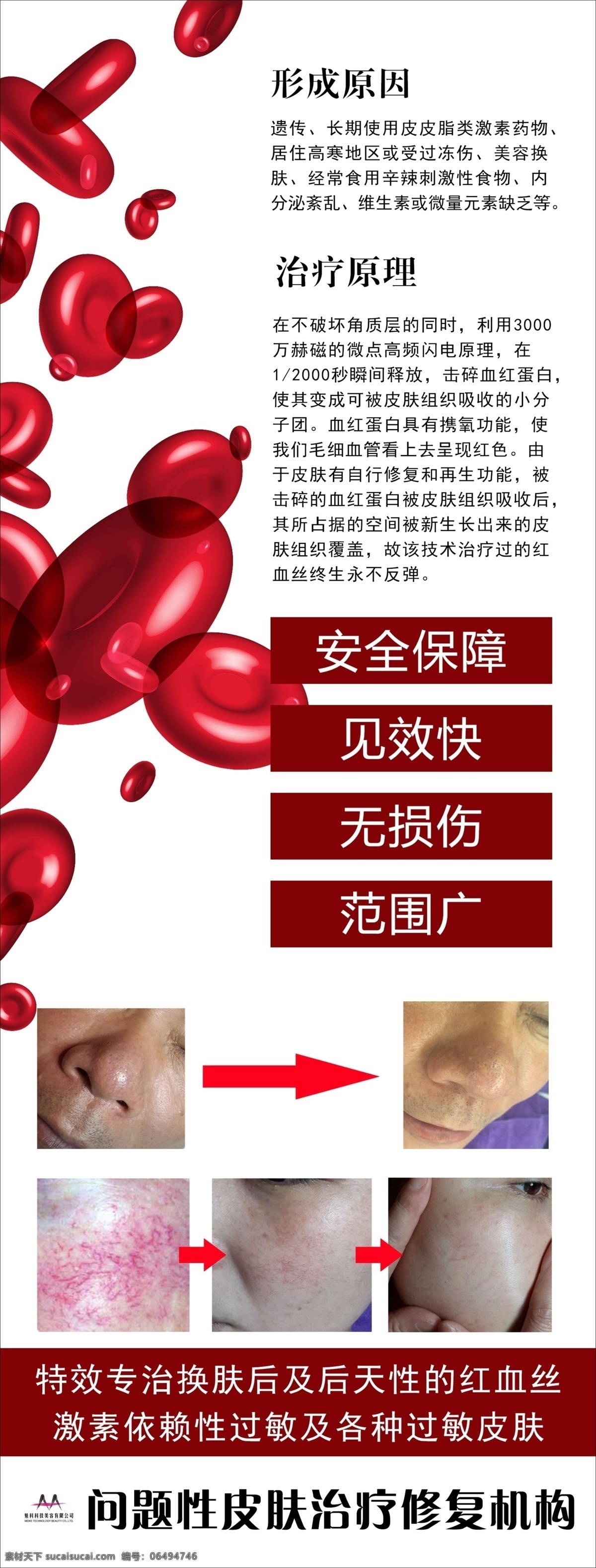 红血丝 简约 医疗 美容 x展架 治疗原理 美容机构 红细胞 形成原因 白色