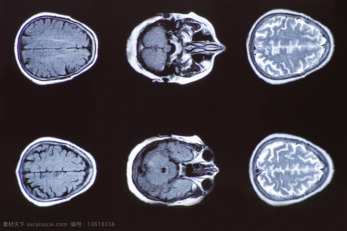 人体 大脑 拍片 医疗护理 医学研究 x光片 x光片图片 x 光 片 医疗 医学研究素材 护理 图片库 现代科技