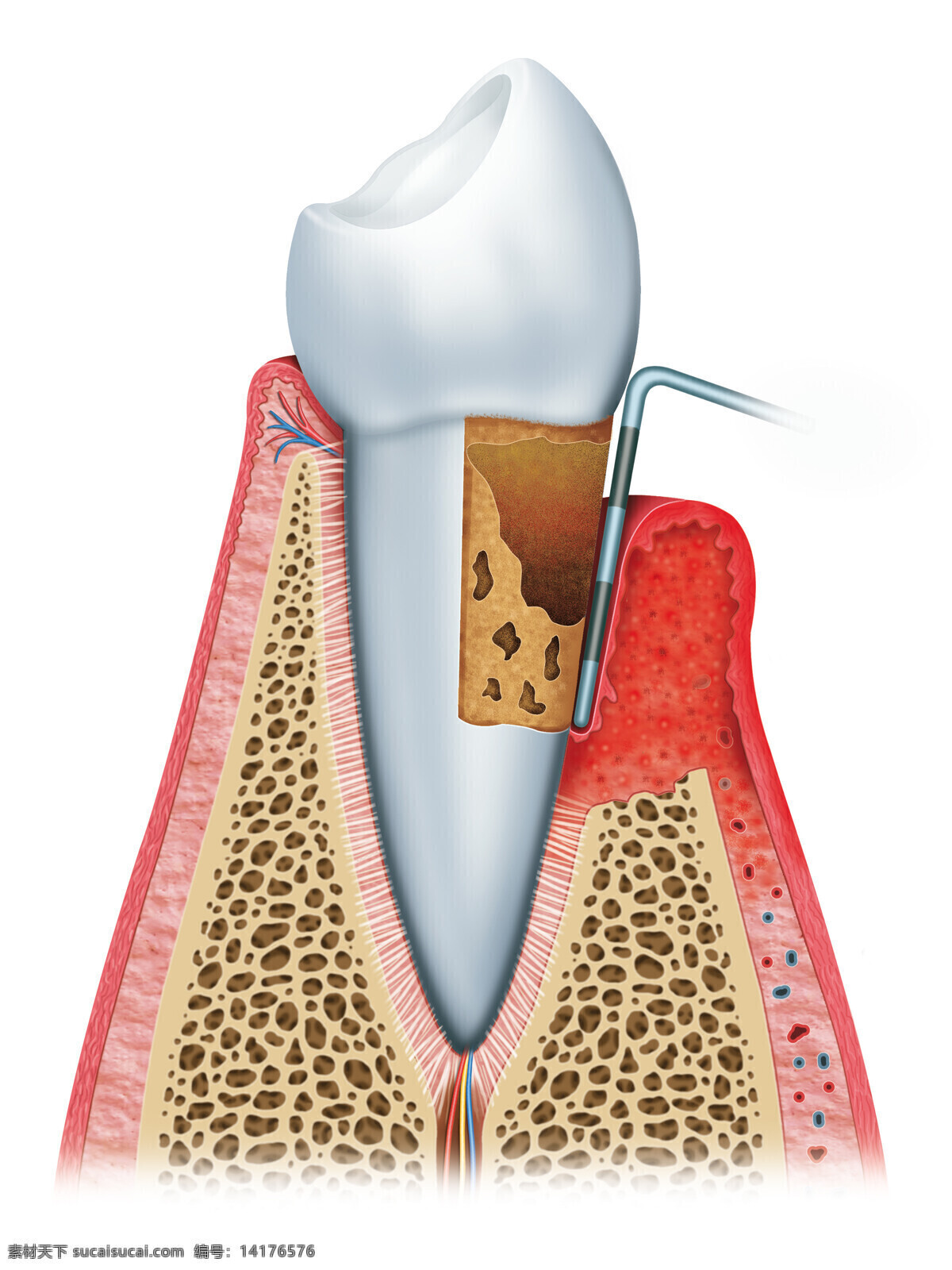 牙齿 修复 效果图 经络 牙龈 牙齿摄影 牙齿种植 假牙 牙科 人体器官 医疗 医院 人体器官图 人物图片
